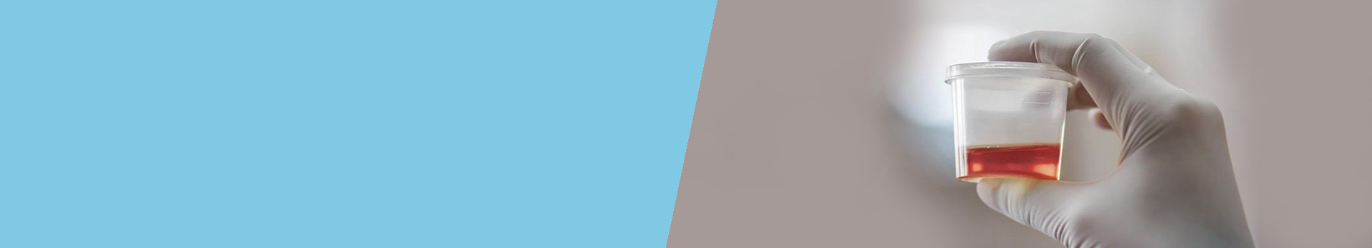 Blood in urine - Symptoms and causes 