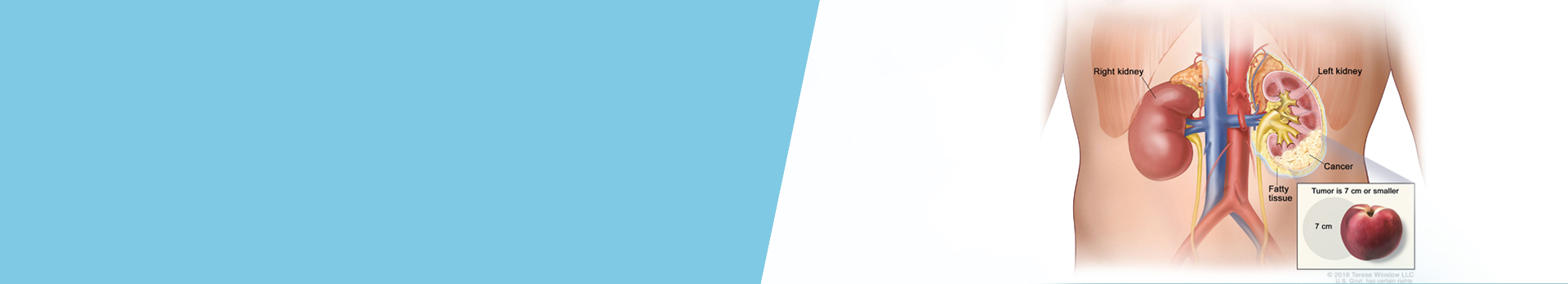 Kidney Cancer - Symptoms, Treatment - Urology 