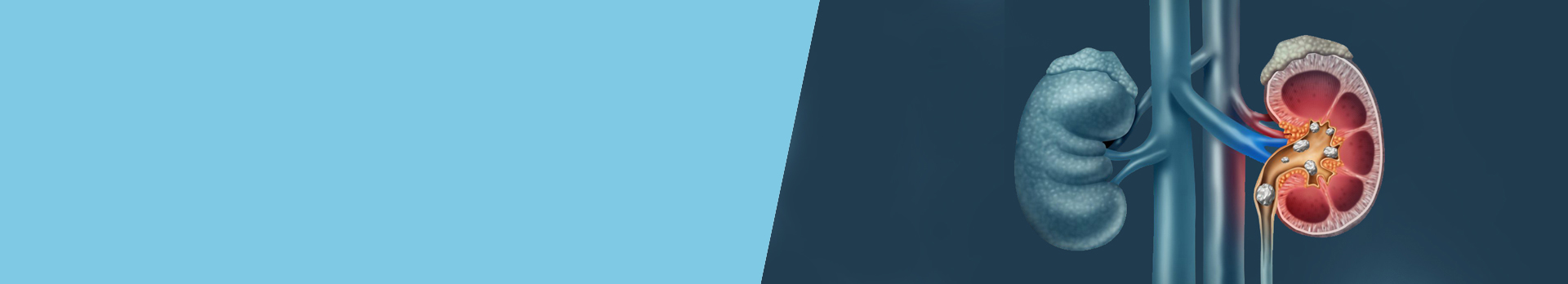 Kidney stones - Symptoms, causes, types, and treatment