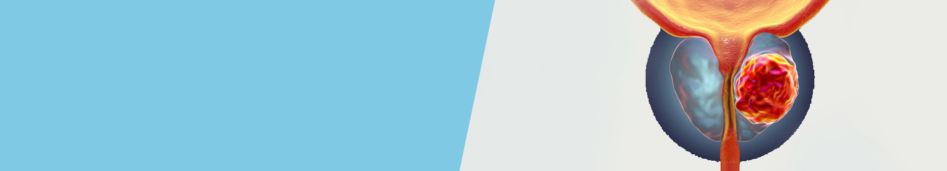 Prostate Cancer - Cancer Treatment In India